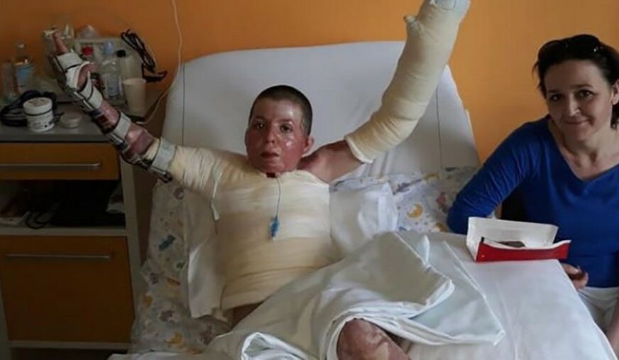 MEDICINSKI FENOMEN Dječaku sa teškim opekotinama davali JEDAN ODSTO ŠANSE da će preživjeti, nakon deset operacija stao na noge