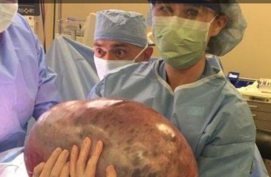 Ženi iz SAD uklonjena CISTA TEŠKA 22 KILOGRAMA, rasla u jajniku i gnječila druge organe