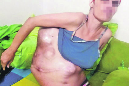 SRPSKI LJEKARI URADILI ŠTO NIKO NIJE SMIO Poslije šest sati operacije Aleksandri su izvadili TUMOR OD 25 KG