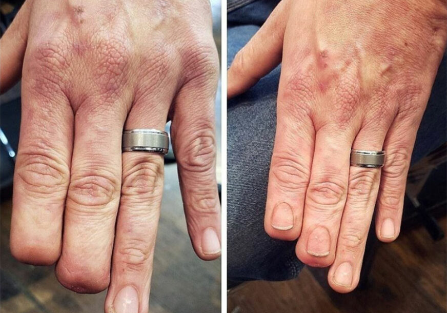 SVAKA ČAST! Majstor tetovaža "vratio" nokte na amputiranim prstima