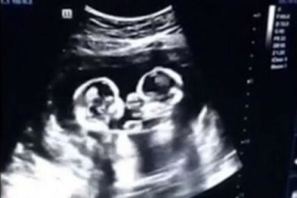 BOKS MEČ U MAMINOM STOMAKU Jednojajčane bliznakinje posvađale su se i prije svog rođenja (VIDEO)