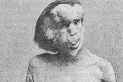 OTKRIVEN GROB ČOVJEKA-SLONA Prikazivali su ga kao nakazu zbog neobičnog oblika glave, a ona ga je na kraju i UBILA