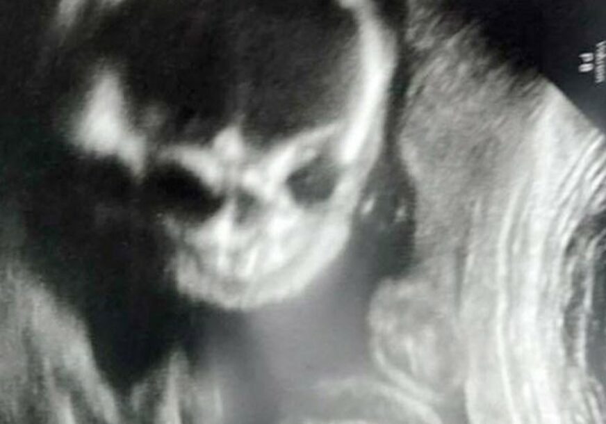„POŽELJELA SAM DA SE NE PORODIM“ Buduću majku uplašila slika ultrazvuka bebe (FOTO)