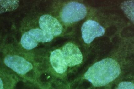 Obećavajući rezultati: Naučnici otkrili kako virusom ubiti ćelije raka