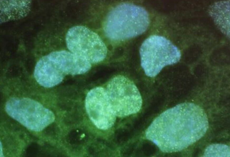 Obećavajući rezultati: Naučnici otkrili kako virusom ubiti ćelije raka