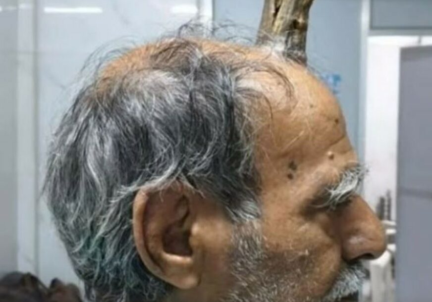 NEVJEROVATNO Muškarcu na glavi izrastao rog, bila neophodna intervencija hirurga (VIDEO)