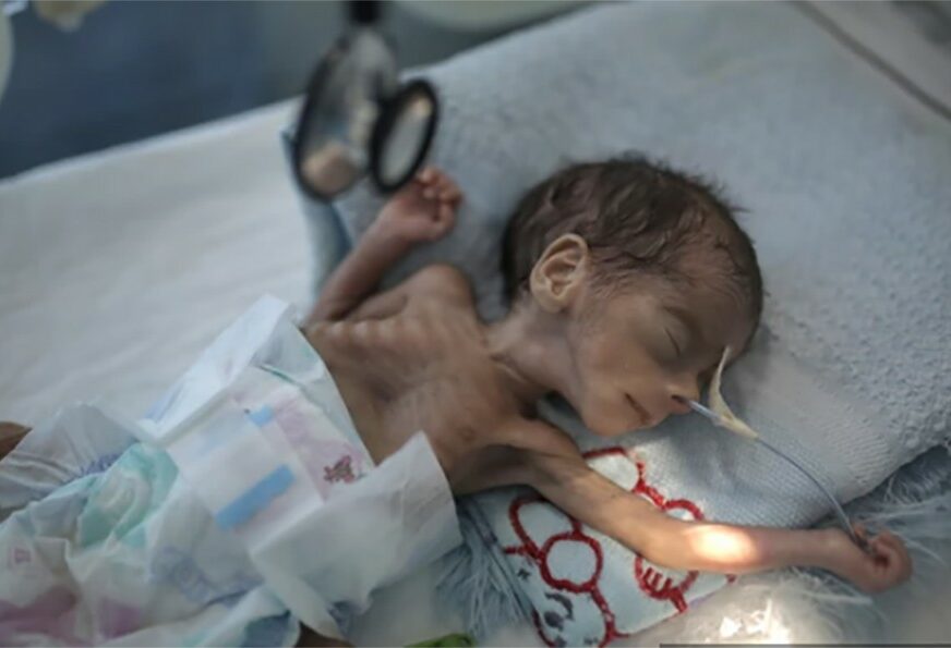 NAJGORA HUMANITARNA KRIZA NA SVIJETU Sav užas rata prikazan na fotografijama NEUHRANJENOG DJETETA