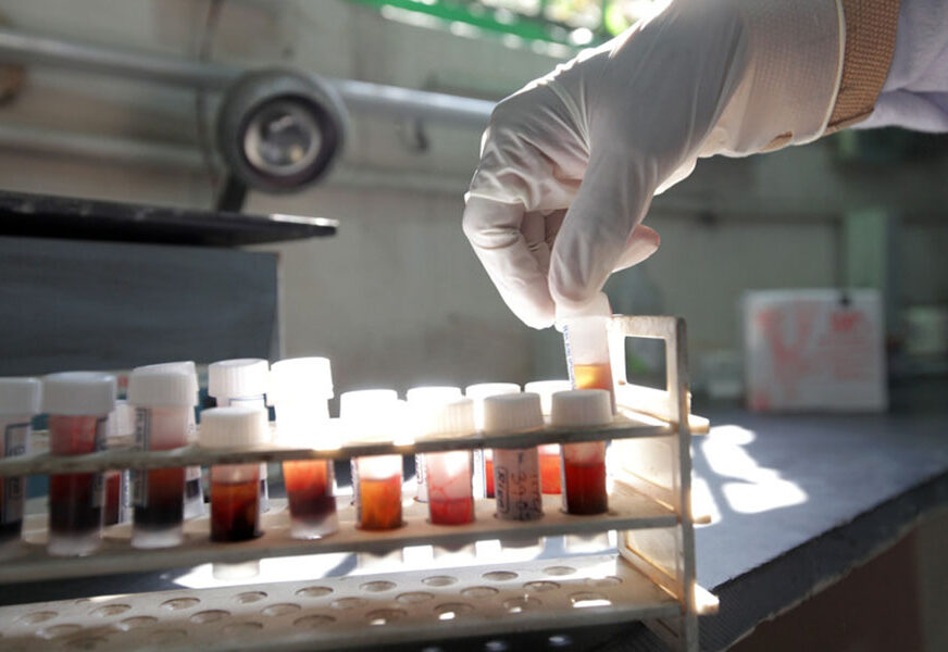REVOLUCIONARNO Izumljen jednostavni test krvi koji detektuje sepsu u roku od 10 MINUTA