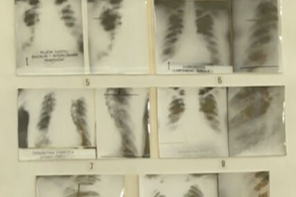 Radiolog upozorava NA OPASNOST: Ljudi sve češće na svoju ruku idu na snimanje pluća