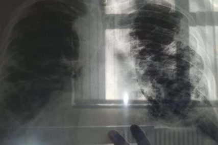 “Ove rupe nisu nastale od metaka" Doktorka iz Kruševca objavila snimak pluća momka koji je obolio od korone