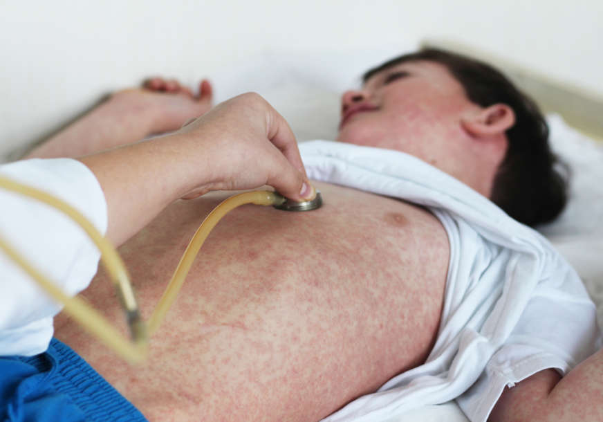 Prijeti li nam EPIDEMIJA MORBILA: U Srpskoj značajno pao procenat djece vakcinisane MRP vakcinom