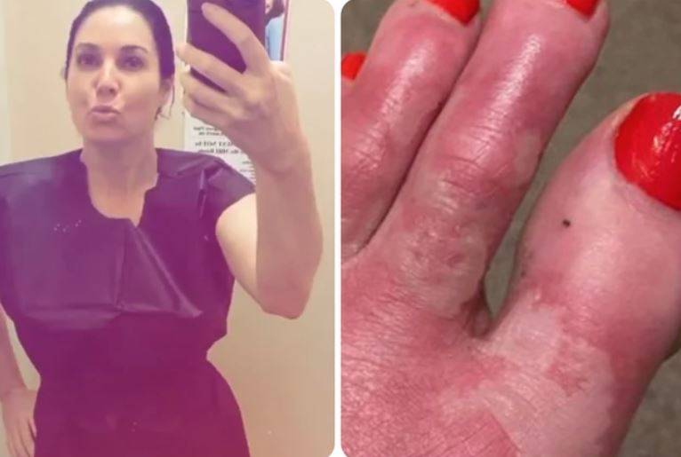 Izašla je na piće sa društvom, a dva dana kasnije, noge su joj bile kao krofne: Otkriveno i šta je dovelo do takve reakcije (FOTO)