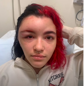 "Momak je vikao šta je sa mojim licem" Tinejdžerka je prošla kroz pakao, a sve zbog farbe za kosu (VIDEO)