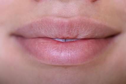 NAJČEŠĆI PROBLEM ZIMI Ispucale usne su česta pojava tokom hladnih i vjetrovitih dana, evo kako pravilno da ih njegujete