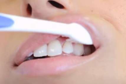STARA DEBATA U kojim slučajevima ne bi trebalo prati zube odmah nakon jela