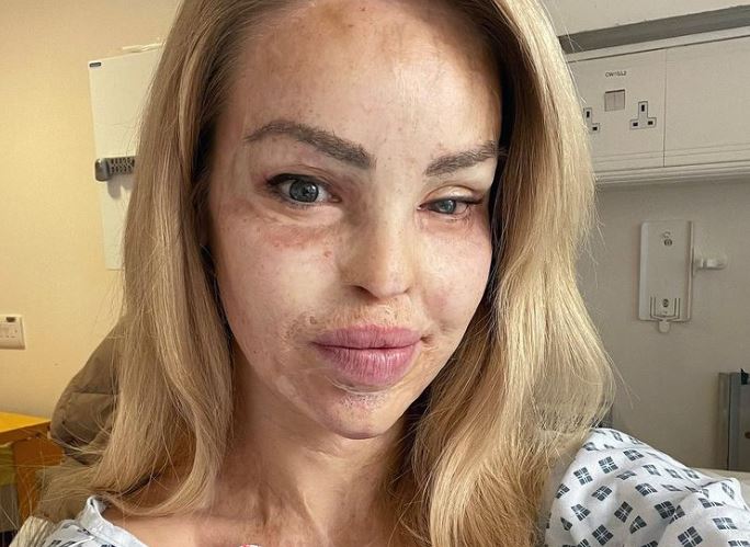Horor priča sa srećnim krajem: Kejti kojoj je bivši prosuo kiselinu po licu pozirala bez ŠMINKE u kupaćem poslije 400 operacija (FOTO)