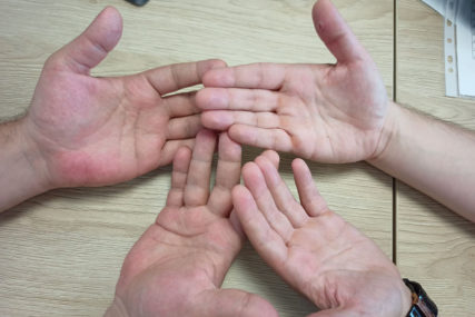 Jednostavan test sa dlanovima: Provjerite da li vašem organizmu nedostaje gvožđe