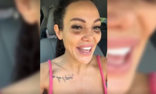 SVA U PODLIVIMA I MODRICAMA Tamara Đurić pokazala kako joj izgleda nos nakon operacije u Turskoj (VIDEO)
