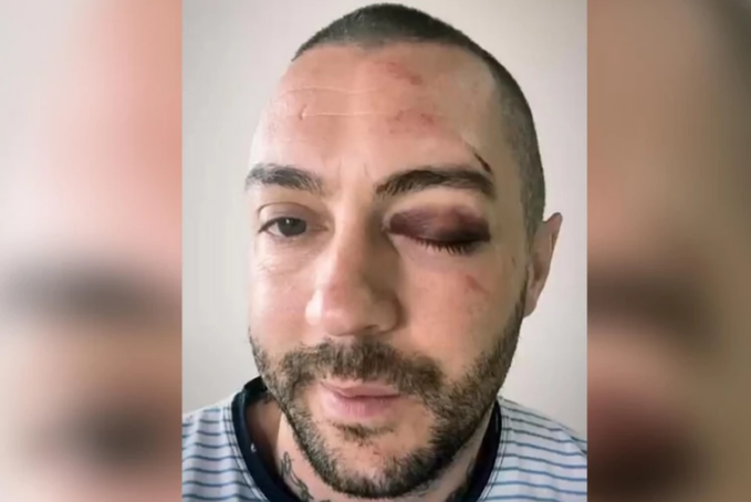 "Pukla mi je čeona kost, moram na operaciju" Komičar Radulović koji je Đokoviću ispričao vic teško povrijeđen (VIDEO)