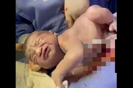 NEVJEROVATAN SNIMAK Samo jedna od 80.000 beba na cijelom svijetu se rodi na ovaj način (VIDEO)