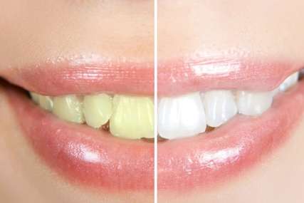Nijansa otkriva mnogo toga: Ako su vam zubi u ovoj boji onda imate OZBILJAN ZDRAVSTVENI PROBLEM