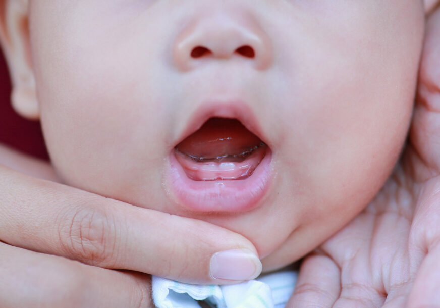 Beba rođena sa zubom