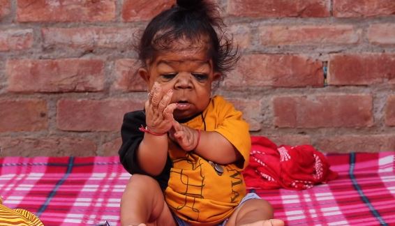 Dječak iz Indije rođen sa teškim poremećajem 