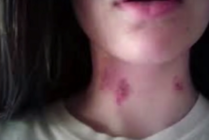 "Šljiva" na vratu nije bezazlena: Žena nakon ljubavnog ugriza doživjela moždani udar