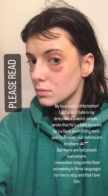 Ruskinja koju je pretukao dečko Srbin