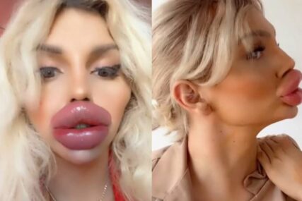 (VIDEO, FOTO) Zbog ovakvih usana JEDVA JEDE I PIJE: Izobličila se od silnih operacija, a tek da joj vidite cimerku  