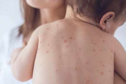 (FOTO) ZAŠTITA OD MASOVNIH ZARAZA Zbog epidemije morbila, direktor Zavoda poziva roditelje na vakcinaciju djece