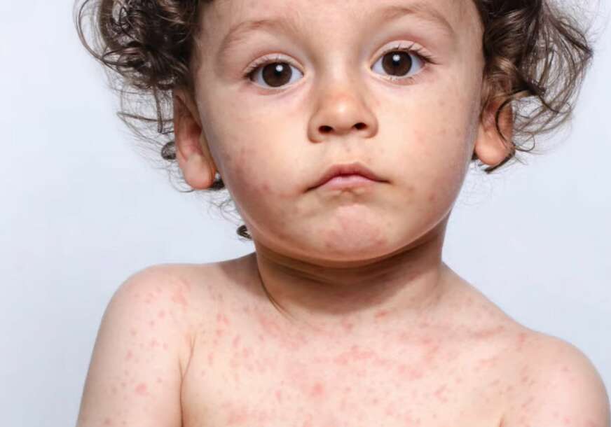 Registrovan prvi slučaj malih boginja: "Riječ je o djetetu od 14 godina, koje je nevakcinisano MMR vakcinom"