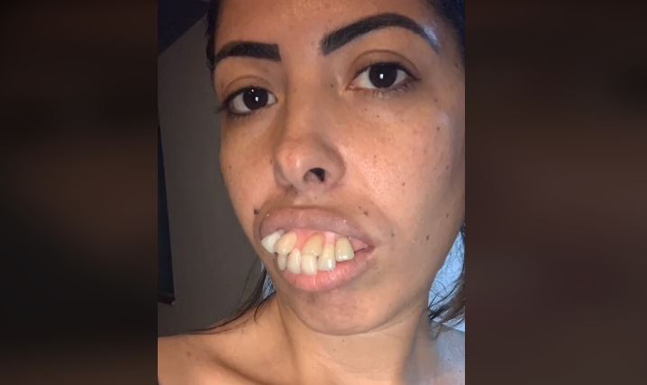 (VIDEO) Ljudi u šoku gledaju njenu transformaciju "Imala sam NAJRUŽNIJE ZUBE NA SVIJETU, a onda sam se udala za zubara”
