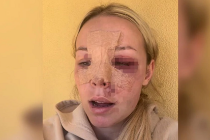 (VIDEO) STRAVIČAN PRIZOR Djevojka jedva preživjela pad sa motora, slomila sve kosti lica