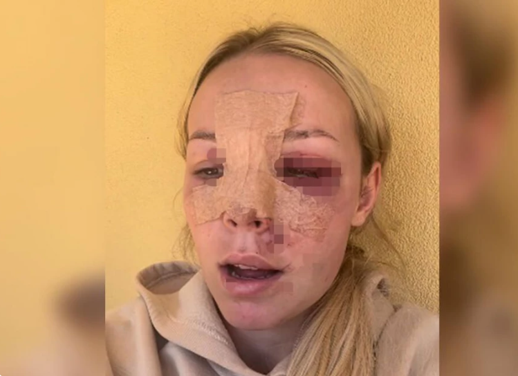 (VIDEO) STRAVIČAN PRIZOR Djevojka jedva preživjela pad sa motora, slomila sve kosti lica