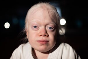 Albino djevojčica iz Turske