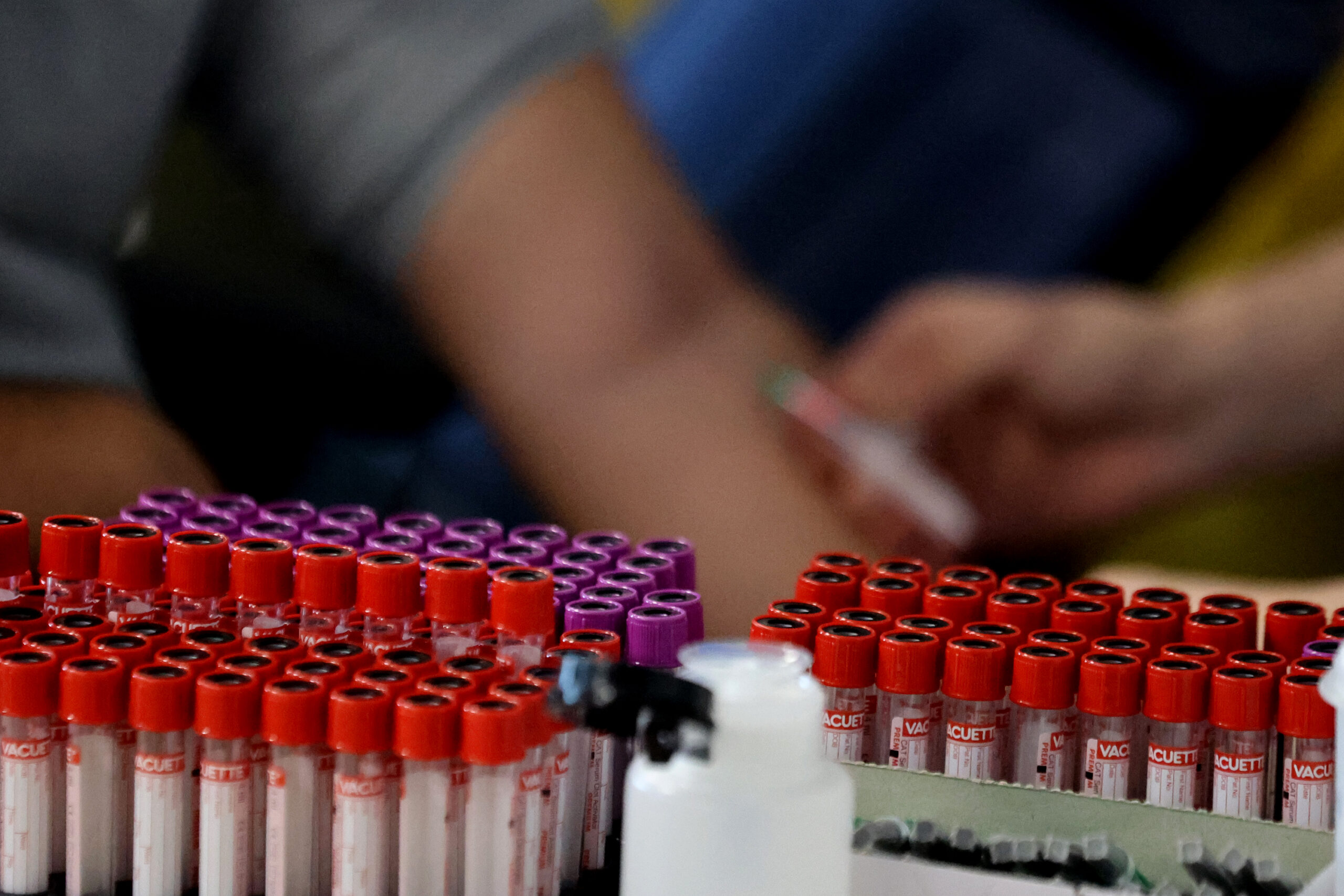 Anemija kod žena, uzroci, simptomi i efikasna prevencija