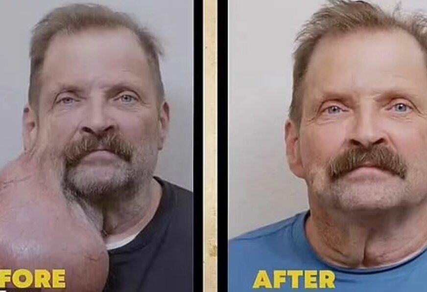 Automehaničaru uklonjen veliki tumor s brade