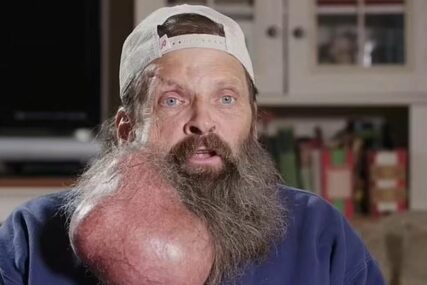 Automehaničar s velikim tumorom na bradi 