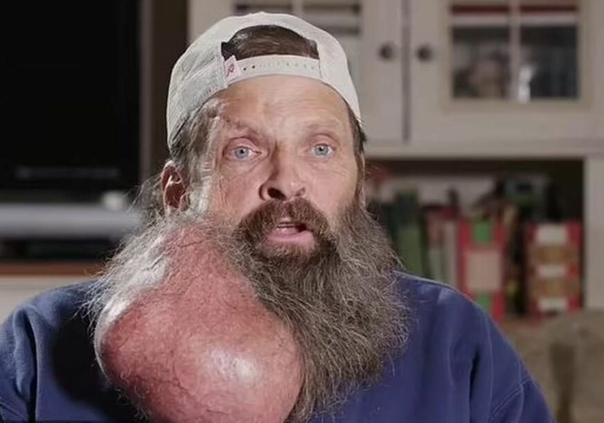 Automehaničar s velikim tumorom na bradi 