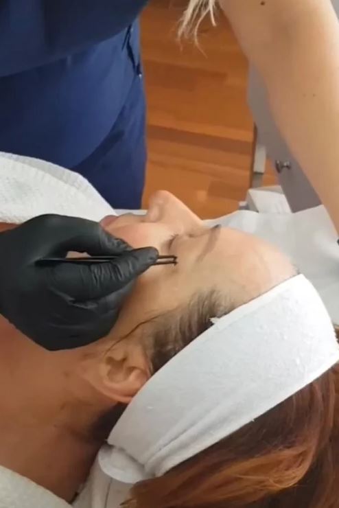 Ana Bekuta se ipak odlučila na ovaj estetski tretman