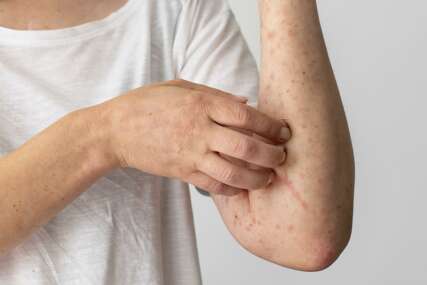 Mnogi ljudi ovo ne znaju: Jutarnje sunce može da ublaži simptome psorijaze