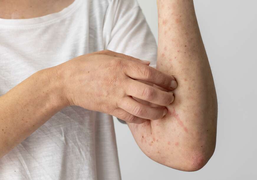 Mnogi ljudi ovo ne znaju: Jutarnje sunce može da ublaži simptome psorijaze
