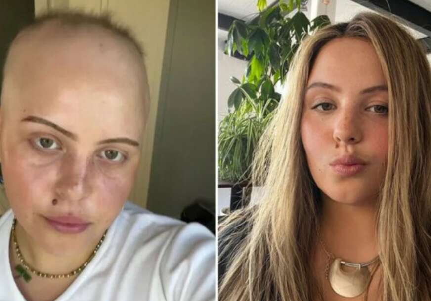 "Kada god bih češljala kosu pod tušem, u ruci bi mi ostajale grudve kose" Lidija (23) je KORONU preležala 8 puta, posljedice su KOBNE