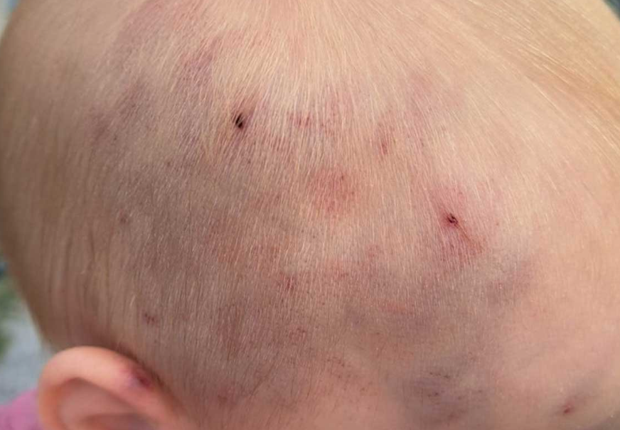 (FOTO) UŽAS U HRVATSKOJ Majka došla u vrtić po bebu i zatekla je sa PODLIVIMA I MODRICAMA