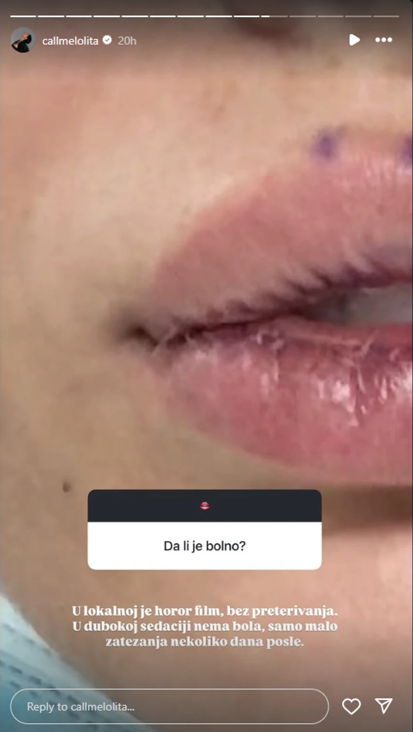 Jovana Švonja o estetskim zahvatima