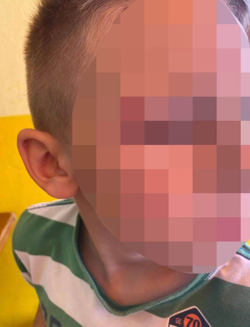 Dječaka vršnjak gurnuo niz stepenice u školi