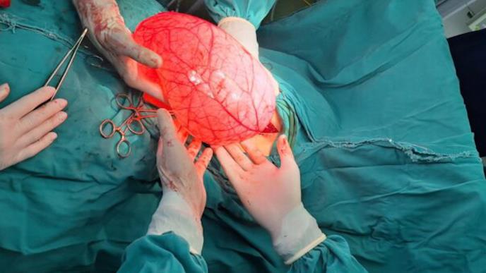 Tumor izvađen iz stomaka djevojčice