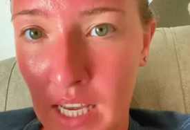 (VIDEO) "Ovo je opekotina koja mijenja život" Helen 2 sata zaspala na plaži na suncu, sada se boji za sopstveni život