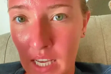 (VIDEO) "Ovo je opekotina koja mijenja život" Helen 2 sata zaspala na plaži na suncu, sada se boji za sopstveni život